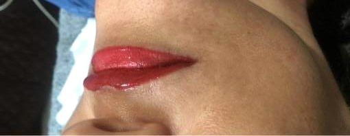 Full lips straight after treatment
