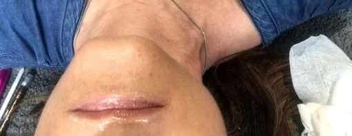 Pale lips before treatment