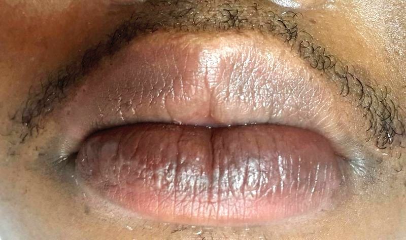 Even lip tone after neutralisation