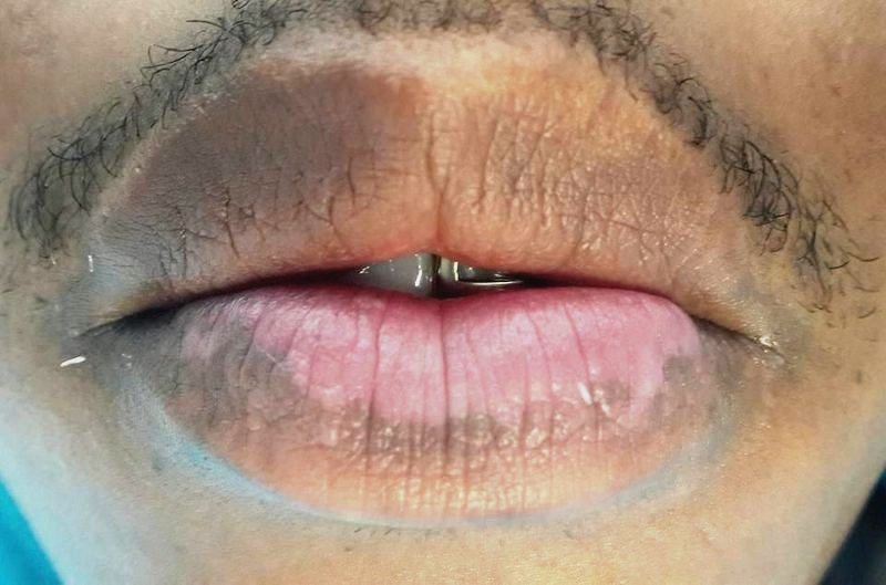 Uneven, darker lips before treatment